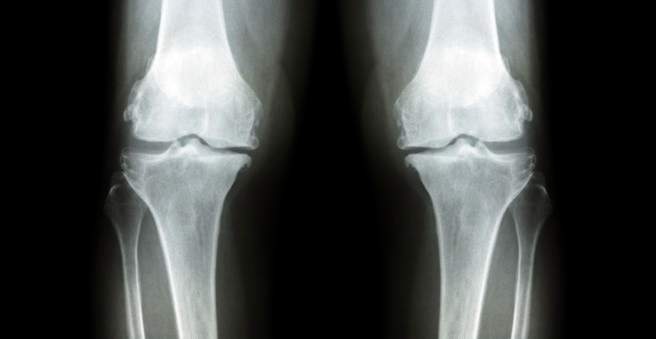 gydymas osteoartrito 3 laipsnio koja