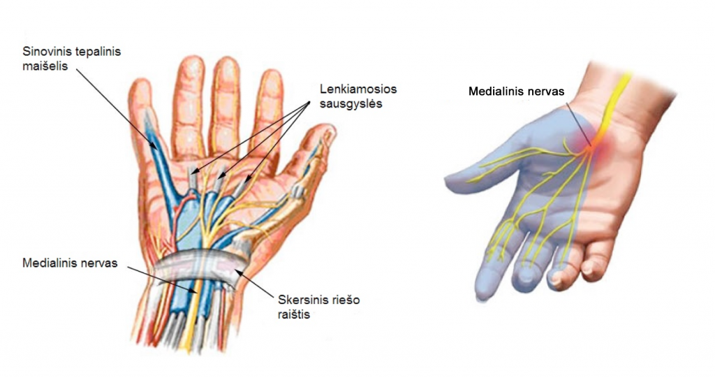 rankos rieso skausmas