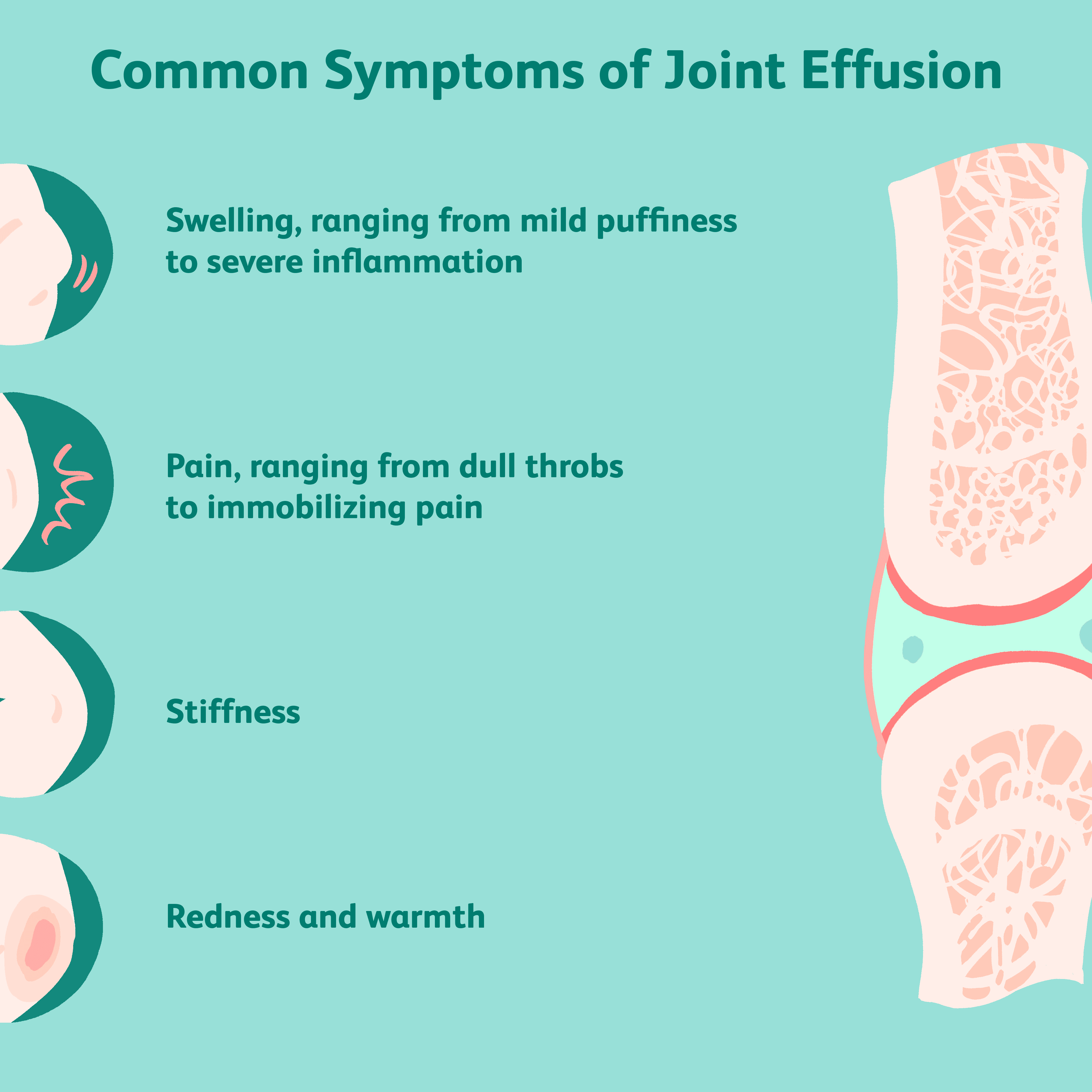 joint edema vs effusion