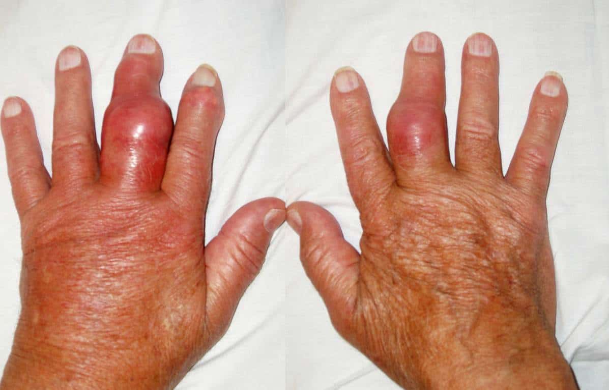 artropatijos sąnarių šepetėliai rankos gydymas