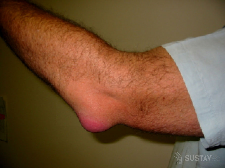 raumenys skauda alkūnės sąnarių ką daryti liaudies būdai gydyti pėdų sąnarius