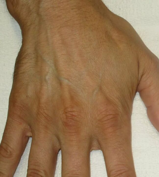 artritas ir didžiuoju pirštu ant rankų pagrindai gliukozaminas ir chondroitino