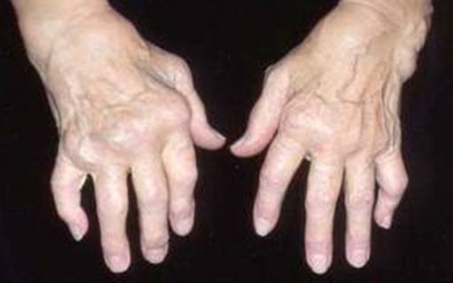 artritas iš rankos gydymas sąnarių osteochondrozė sustaines riešo