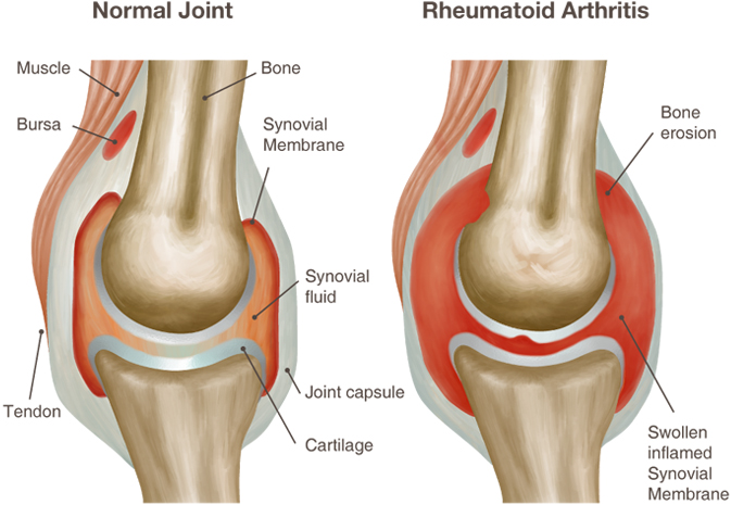 artritas artrito liaudies gydymo metodai