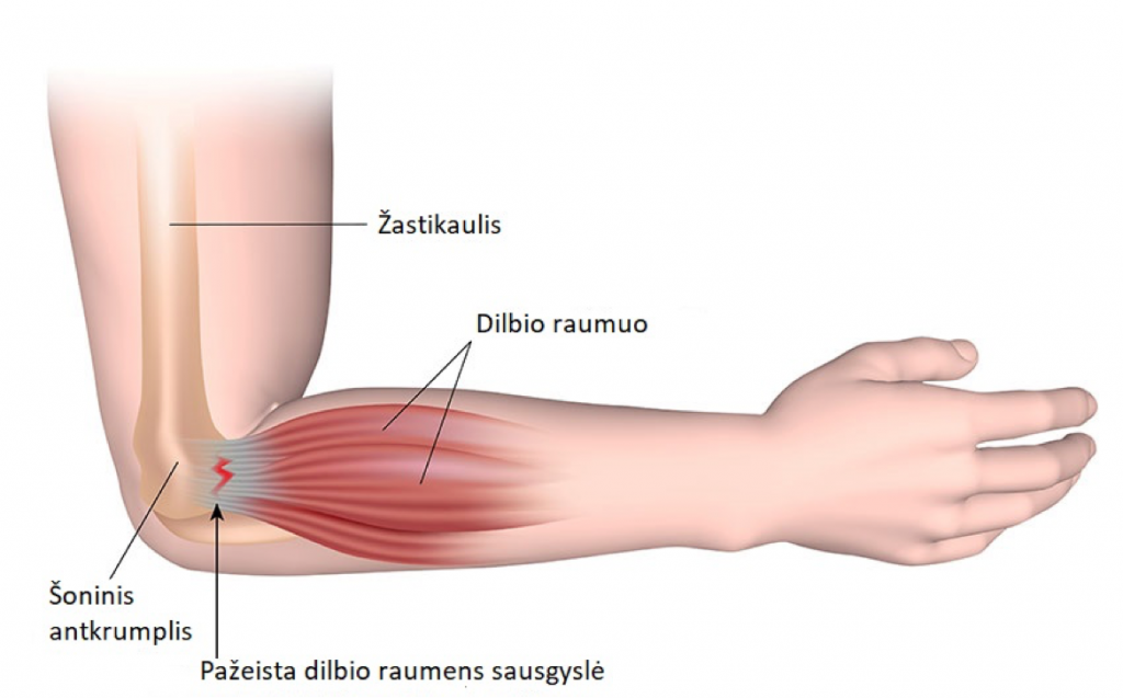 tepalas į alkūnės sąnario artrozė