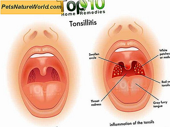 lėtinis skausmas tonsillic namų receptai osteoartrito gydymui