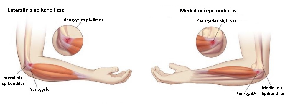 rankų raumenų skausmas