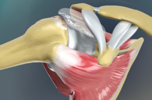 peties raumens patempimas priemonės skausmas rankose sąnarių