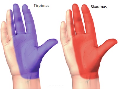 osteoartrito mažų sąnarių rankas gydymo rankas gydymas artrozės šepečiu
