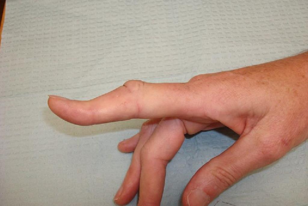 artrozė sulyginti rankų pirštus
