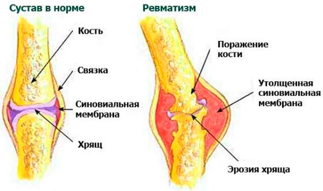 gydymas sąnarių artritas artrozė