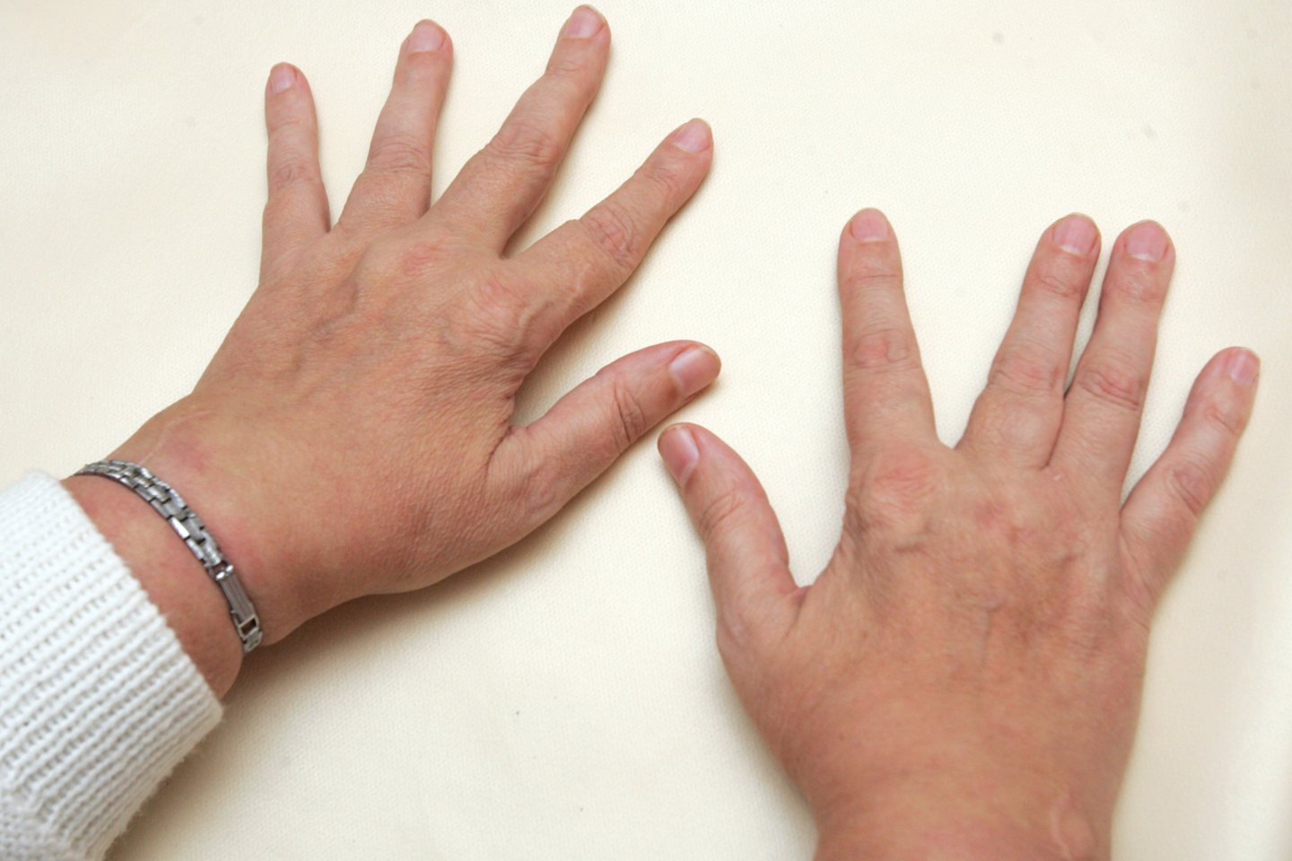 artrito apie pirštą gali sukelti sąnarių tempimo žalą riešo