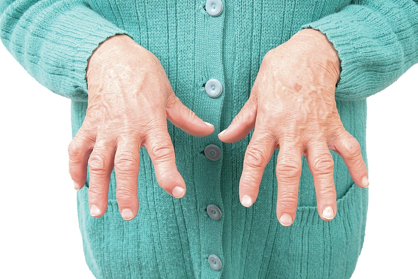artrito rankas pasekmės rotveileris gydymas sąnarių