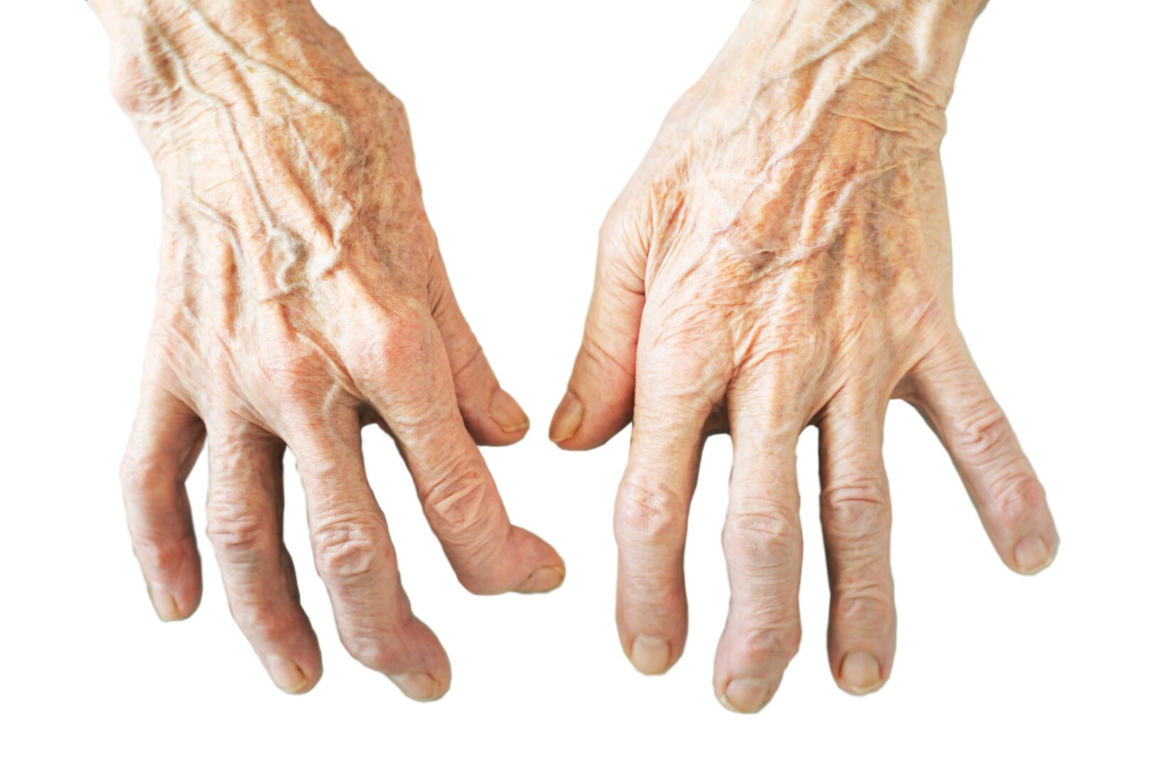 artrozė iš sakroiliinių sąnario rankos bendra kairėje plaštakoje ranka priežastys ir gydymas