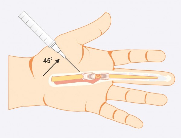 skausmas pirštų bendrų rankas lenkimo gydymas finger finger uždegimas
