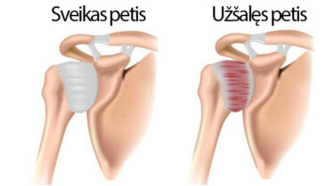 polyarthrites peties sąnario judesių gydymas skausmas raumenyse ir sąnariuose apatinėje nugaros gydymas