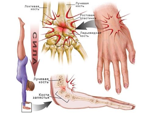 liaudies būdai gydyti artrozės pirštus