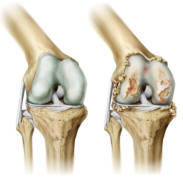 artrito sąnarių kaire koja judėjimo sąnarių gydymas