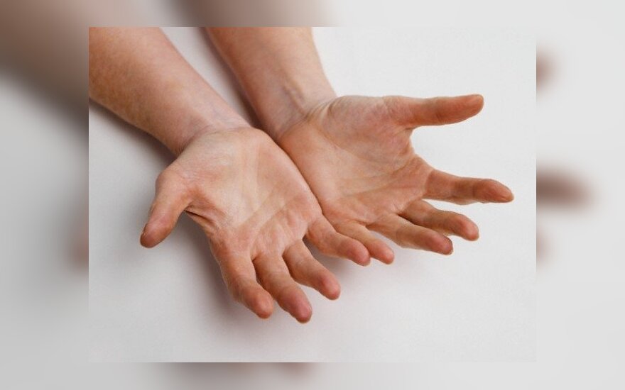 osteochondrozė iš šepetėliai rankų sąnarių
