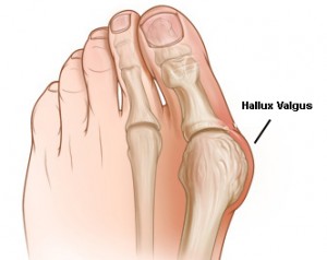 artrozė nykščio pėdos gydymas namuose