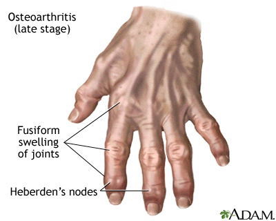 swelling in various joints karminės sąnarių ligų priežastys