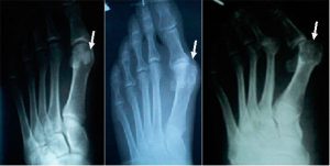 artritas ir mizintsy swelling in finger joints
