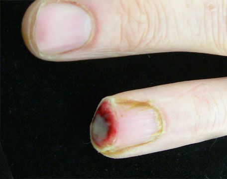 rankų traumos ant piršto sąnarių liga poli-ranka