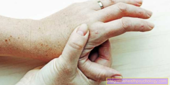 skauda sąnarį po virvių reumatoidinis artritas komplikacijos