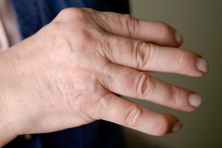 swelling in joints on one side of body gerklės sąnarių ir paprastumas