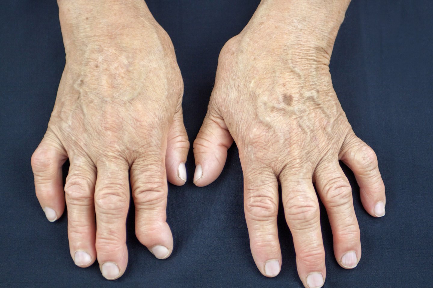 gydymas artritas ir artrozė senyviems žmonėms