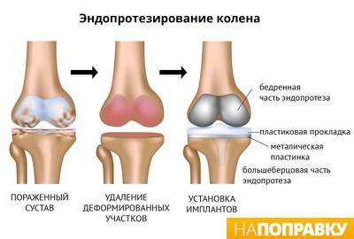 gydymas osteoartrozės pėdos sąnarių liaudies gynimo priemones crunch sąnarių pečių raumenų skausmas