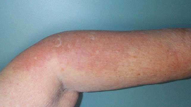 swollen painful joints and hives zhilbera sindromas skausmas sąnariuose
