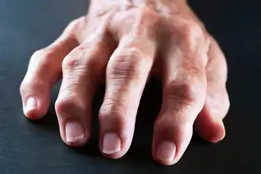 swelling in finger joints with pain artritas iš šepečiai ir sustabdyti sąnarių