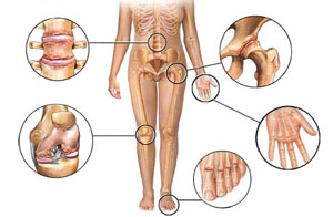 artritas sustav falang rankos