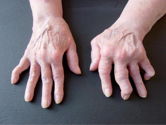 artritas suglobіv rankos gliukozaminas chondroitino tabletės kainų struktūra
