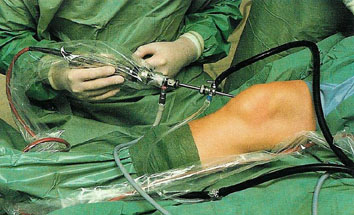 artroskopinė kelio sąnario operacija išlaikyti skausmą paleidus