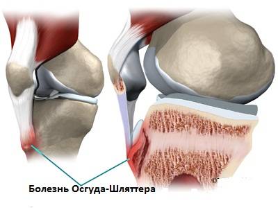 artritas nykščio gydymas liaudies gynimo gydymas osteoartrito ir bursito peties sąnario