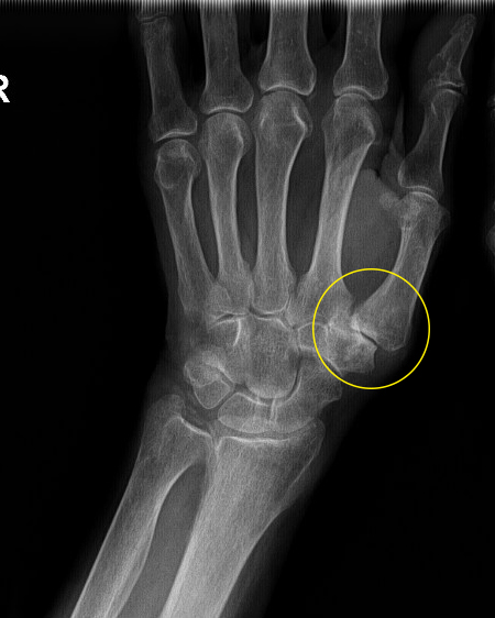artrozė iš rankų gydymui nykščio artritas piršto rankas nelenktų