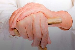 artritas pirštai kaip pašalinti skausmą