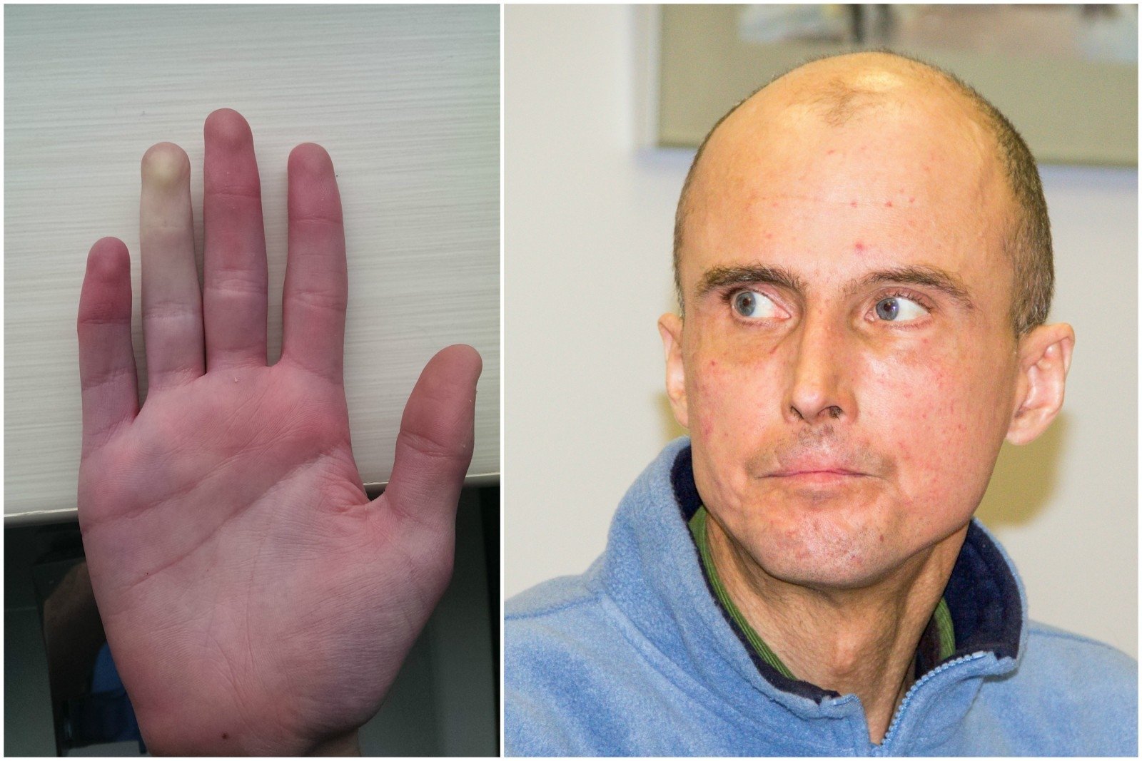 artritas mažų sąnarių nuo tos priežasties priežasčių rankomis sukelia nuo iš rankų rankų sąnarių skausmo
