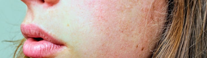 odos paraudimas su sąnarių uždegimas beržų lapai dėl artrozės gydymo