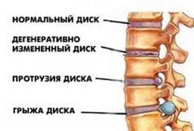 eglės-naftos valymo artrozės