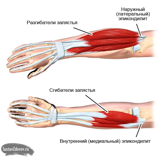 įgūdžių skausmas gydymas artrozė rankų atsiliepimus