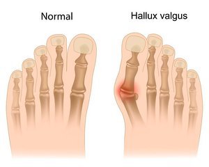 artritas pirmojo piršto pėdos balzamų osteochondrozė