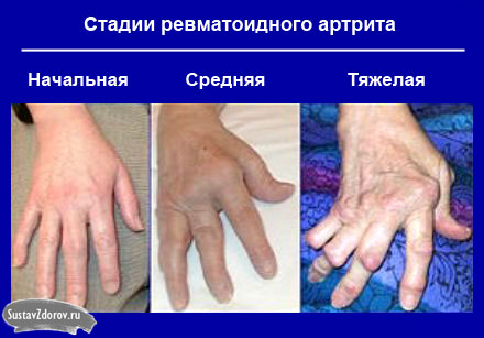 reumatoidinis artritas yra bendra