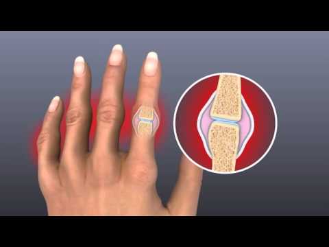 swelling in knuckle joints false bendra kaklo šlaunies skausmas