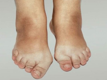 liaudies gydymo pėdos osteochondrozės