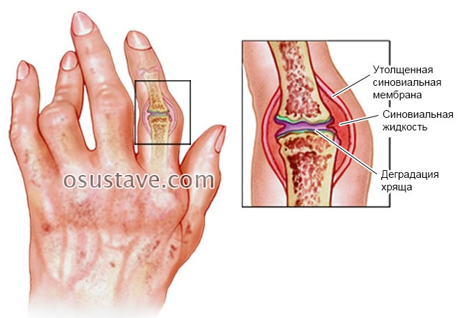 sąnarių įvyksta artrito traškūs sąnarių gubric artritas