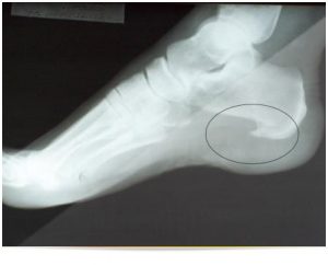 artrito gydymui reumatoidinis artritas skauda ranką