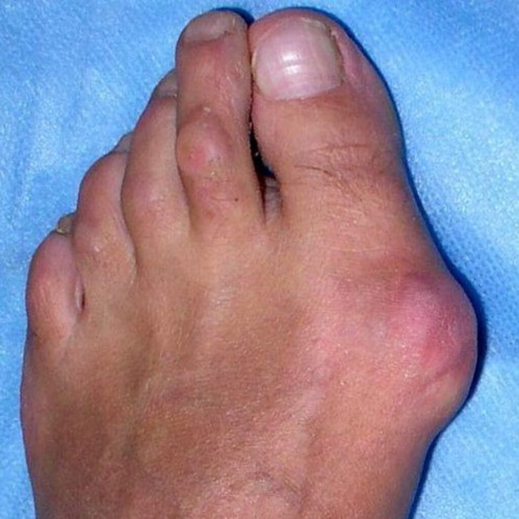 kūgis ant pėdų gydymui sąnarių nutekėjimą ir geliai osteochondrozės